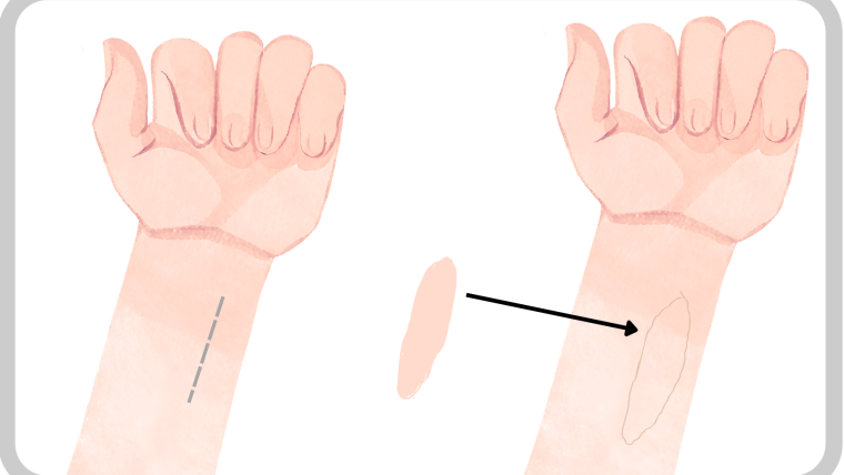 Illustration of inserting the skin patch on an arm.
