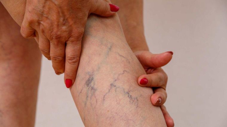 Varicose veins on a woman's leg