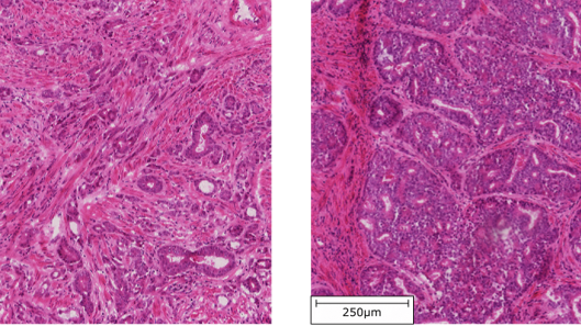Prostate cells from the same patient, showing cribriform transformation on the right. Cribriform pattern prostate cancer has poorer prognosis.