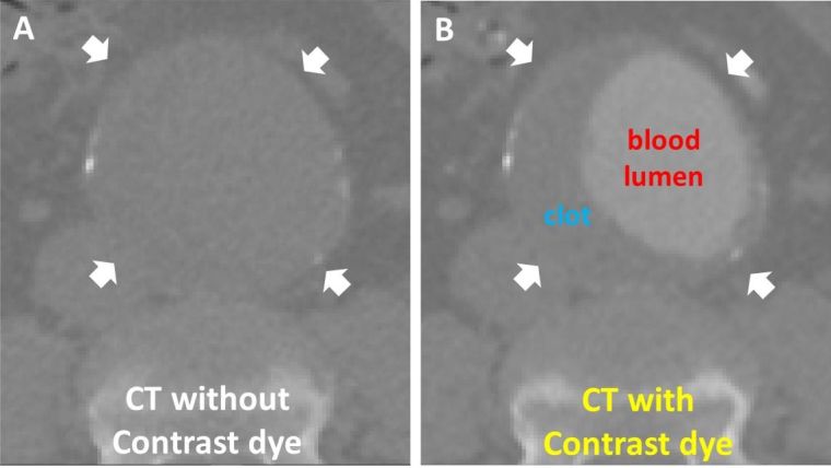 CT without contrast dye (Figure A) and CT with contrast dye (Figure B)