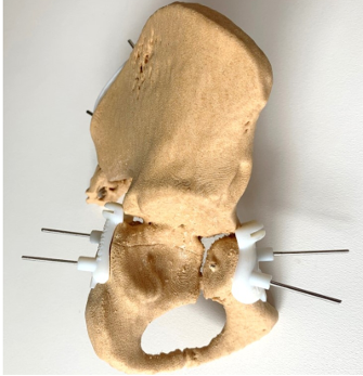 Example of 3d printed models and tumour cutting guide to allow safe resection